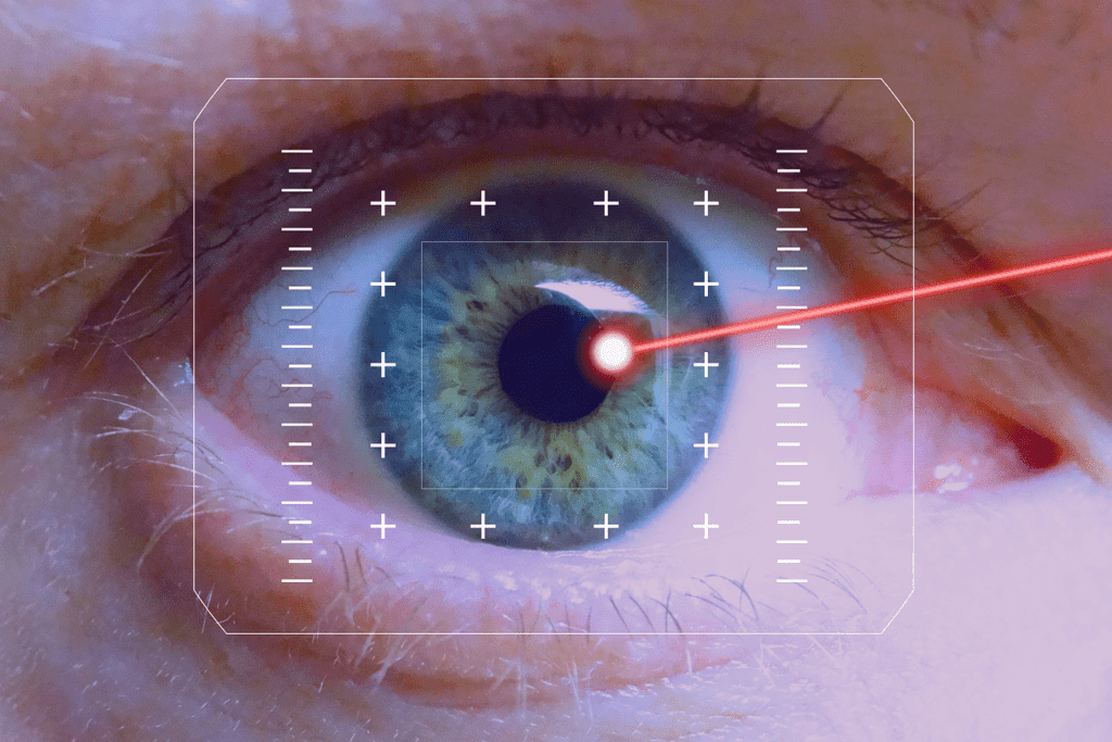 Augenlasern Bild