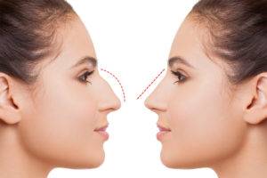 Was sind die Vorteile der geschlossenen Rhinoplastik?