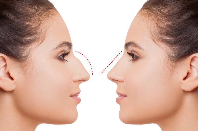 Was sind die Vorteile der geschlossenen Rhinoplastik?