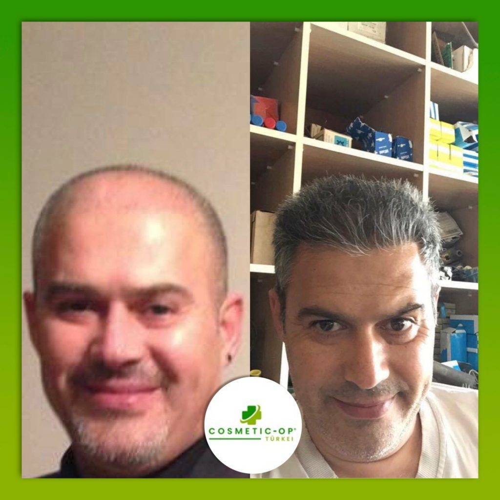 Hair-Transplant-Cosmetic-OP-3_1