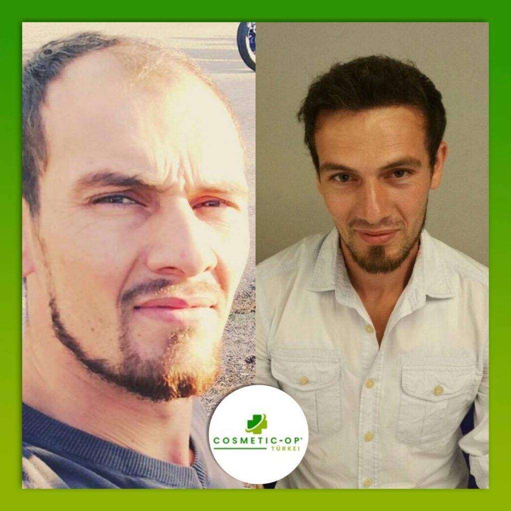 Hair-Transplant-Cosmetic-OP-4_1