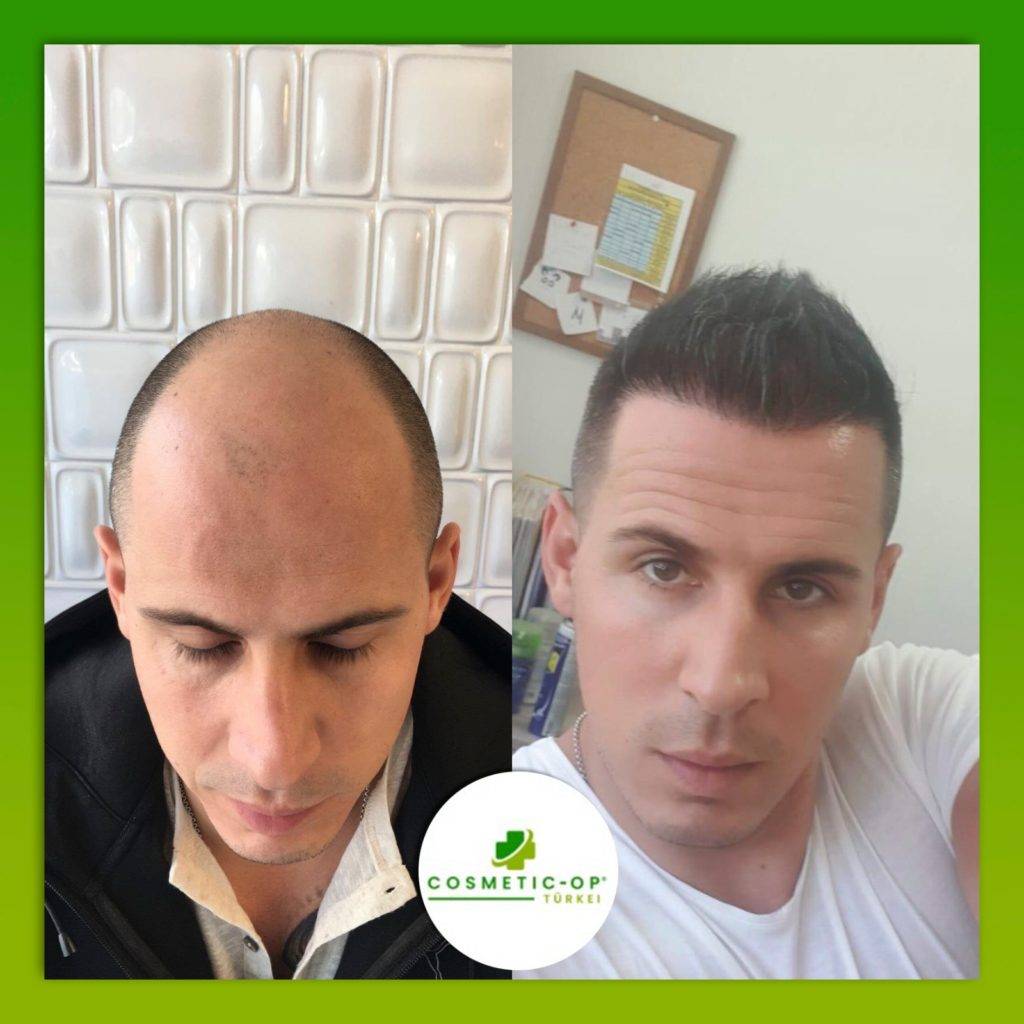 Hair-Transplant-Cosmetic-OP-5_1