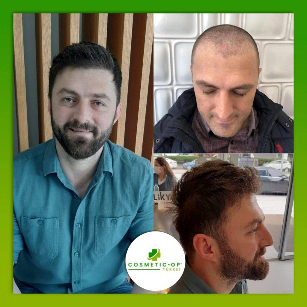 Hair-Transplant-Cosmetic-OP-7_1