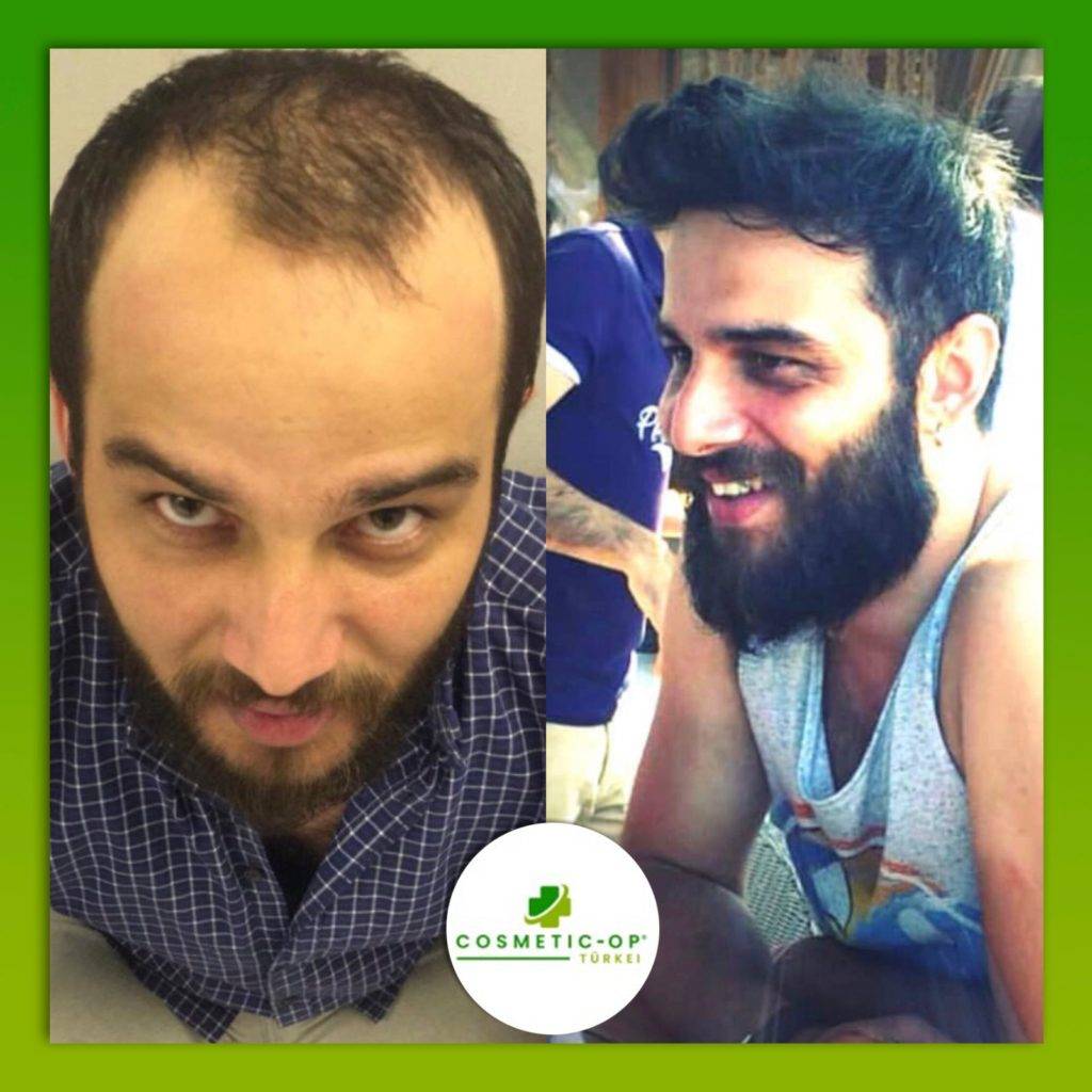 Hair-Transplant-Cosmetic-OP-8_1