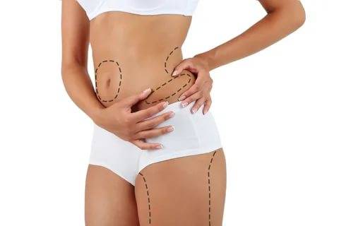 Liposuktion/Fettabsaugung